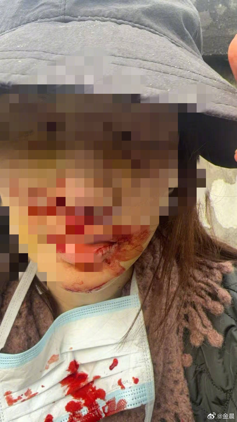 警方发布警情通报后,金晨晒脸部受伤照片并发文道歉